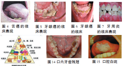 人乳头状瘤的患者和携带者是主要的传染源,亦可导致疣状癌.