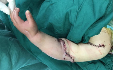 折翼小天使的新生——北京积水潭医院手外科成功实施婴幼儿断臂再植