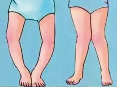 在临床上,碰到的绝大部分的内翻和外翻这种腿部畸形都是骨性结构导致