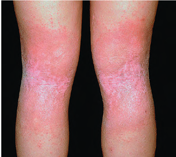 积医科普身上奇痒无比特异性皮炎该怎么治