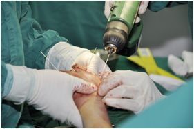 小儿骨科急救医生为孩子打钢钉