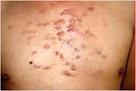 科室动态- 北京积水潭医院皮肤科门诊开设瘢痕综合治疗门诊-北京积水潭医院