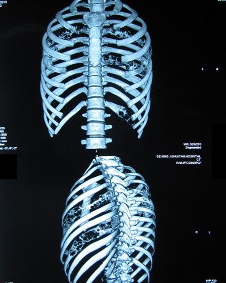 本图为一多发肋骨骨破坏患者的肋骨三维重建影像,可见左侧5,8,12肋